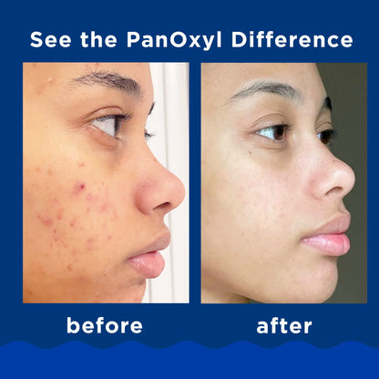 غسول بانوكسيل رغوي لحب الشباب بنزويل بيروكسيد 10% – 156جم Panoxyl Acne Foaming Wash Benzoyl Peroxide 10%